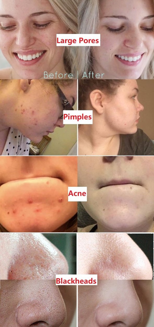 Natural Green Tea Clay Mask Stick– Clears Acne & Refines Pores🌿