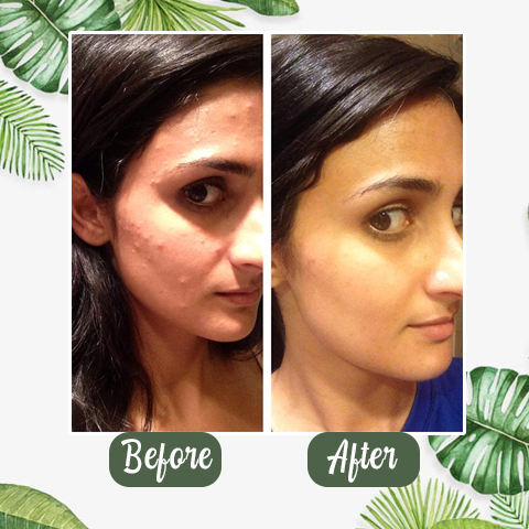 Natural Green Tea Clay Mask Stick– Clears Acne & Refines Pores🌿