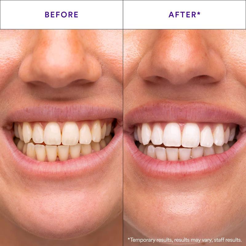 🌸 Brighten Your Smile with Purple Whitening Strips 💜✨