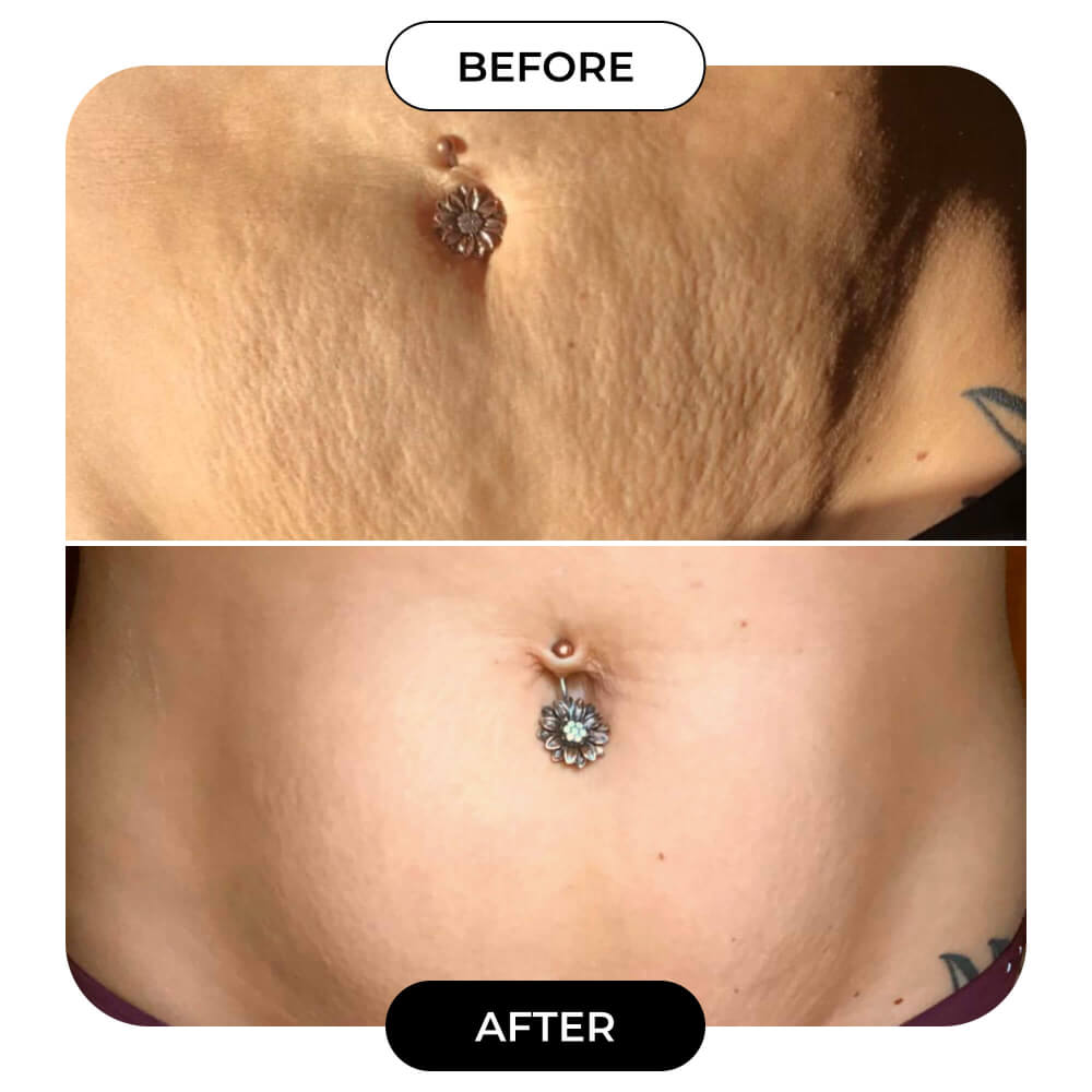 🔥 Black Friday Deal! Belly Firming Cream – Targets Stretch Marks & Loose Skin, Clinically Proven, With Avocado Extract